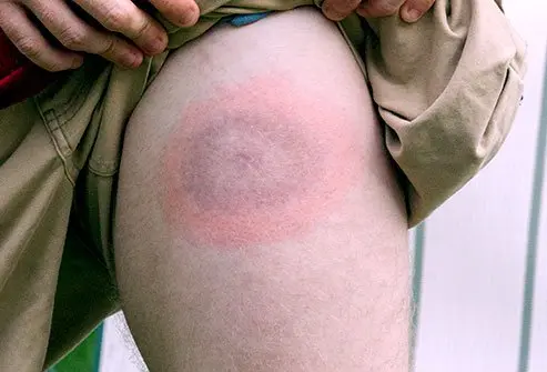 Chronic Lyme disease and tick-borne illness assessment